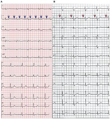 Frontiers | Case Report: Complete Atrio-ventricular Block Successfully ...